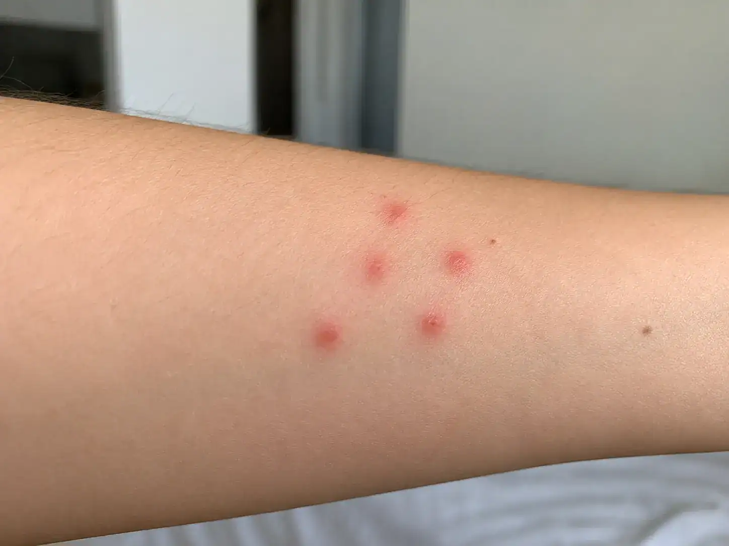 piqûre punaise de lit boutons rouges groupés sur la peau